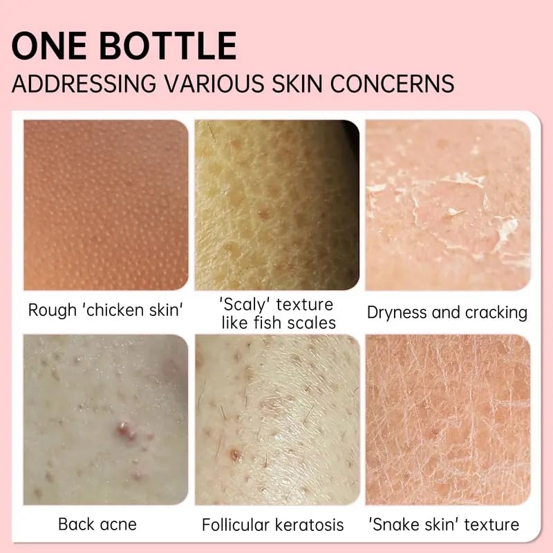 Keratosis Pilaris Lotion, Legs Treatment Body Cream Skin Exfoliating Repair Cream Chicken Skin Care Cream,Exfoliating Body Cream Rough Bumpy Skin Body Lotion Moisturizing Cream Gets Rid Of Redness