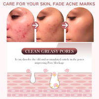 ISBEAUSOLS 2pcs Acne Tratment Face Gel 15% Acid - Spot Treatment For Face - Acne Treatment for Spot Prone Skin - Spot Gel for Women,Men,Teenager - Clean Skin,Pimple Reduce,Blackhead Remover