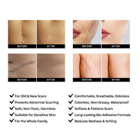 AZALLY Advanced Scar Gel - Scar Diminishing Serum - Reduces The Appearance of Old & New Scars - Best Scar Treatment for Repair Scars from Burns Cuts Acne Spots Stretch Marks