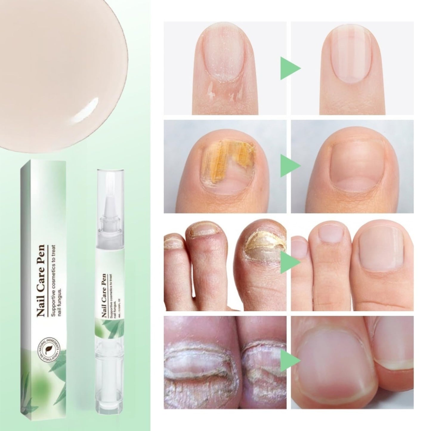 2PCS Nail Care Pen & Serum,Nail Revive Pen,Fungel Nail Treatmant Pe/n,Toena/il Fungas Treatmant P/en,To/enails Repair Pe/n,Nai/l Repair Essence for Toena/il and Fingernails,Fungel N/ail trea/tmant