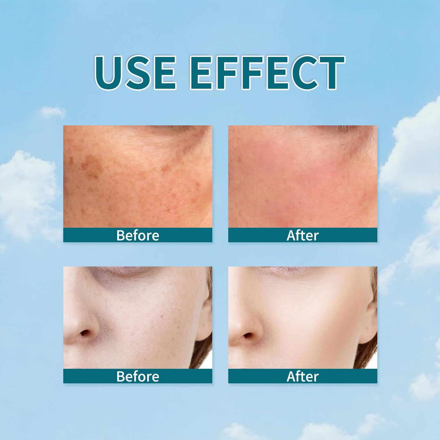 GNAUMORE Freckle Remover Cream,Dark Age Spot Remover,Spot Cream Dark Spot Corrector,Reduce Dark Spots & Soften Skin,Hyperpigmentation Treatment,20g