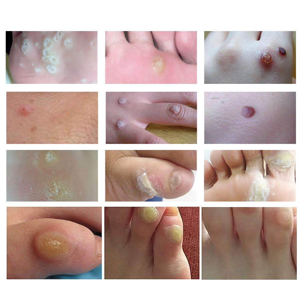 Cherioll Wart Remover, Corn Complete Removal, Corn Remover, Foot Corn Remover Pads, Plantar Wart Removal, Penetrates and Removes Common and Plantar Warts, Callus, Stops Wart Regrowth