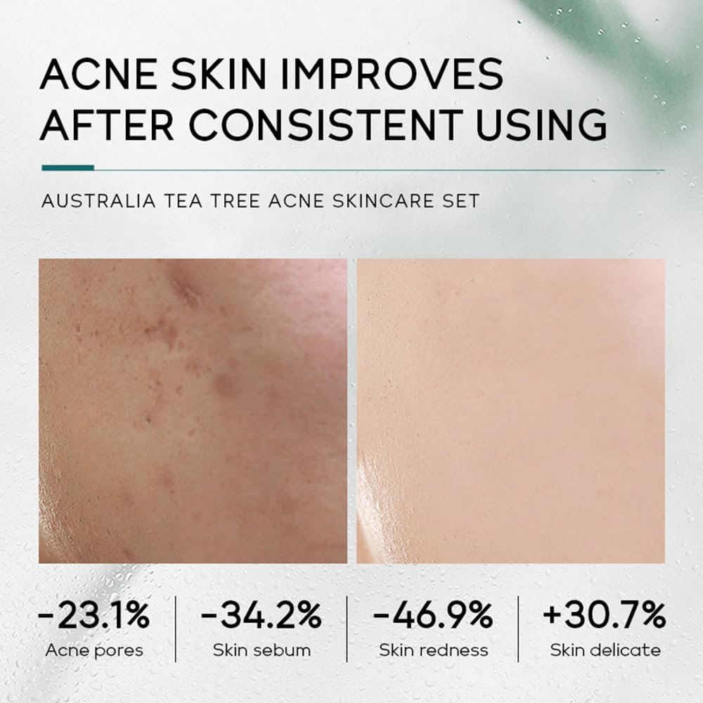 LAIKOU Skincare Gift Set for Teenagers Girls, Tea Tree Skin Care Sets & Kits with Cleanser,Toner,Serum,Face Cream,Gel, Shrink Pore/Acne Remove Oil Control Facial Kits for Women, Suitable for All Skin