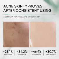 LAIKOU Skincare Gift Set for Teenagers Girls, Tea Tree Skin Care Sets & Kits with Cleanser,Toner,Serum,Face Cream,Gel, Shrink Pore/Acne Remove Oil Control Facial Kits for Women, Suitable for All Skin