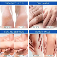 Urea Cream, 45% Urea Foot Cream, Foot Cream for Cracked Heels and Dry Skin Athletes Foot Cream Cracked Heel Repair Cream Cracked Heel Repair Cream for Feet and Hand