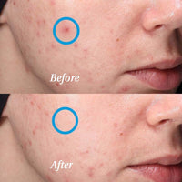 the superdots. The Superdots Invisapatch Repair Barrier, 44 Ultra-Thin Spot Patches