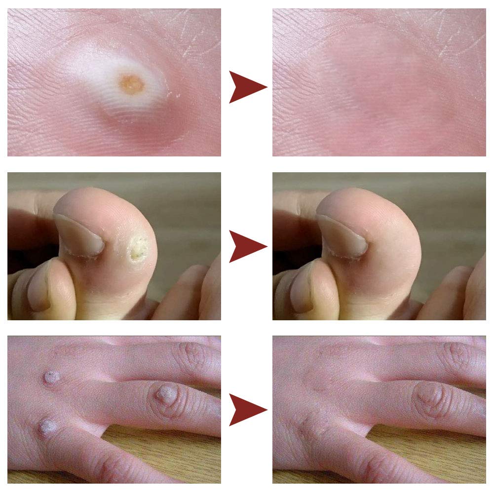 Corn Remover Wart Remover Corn Removal Corn Remover for Feet, Callus Remover, Cuticle Remover, Corn Remover Liquid to against Corn & Wart,15ml
