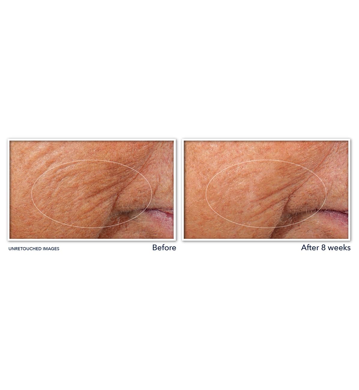 RoC - Retinol Correxion Line Smoothing Night Serum Capsules - Daily Anti-Wrinkle & Anti-Aging Treatment - Visibly Reduces Fine Lines & Wrinkles - Overnight Skincare - 10 Capsules