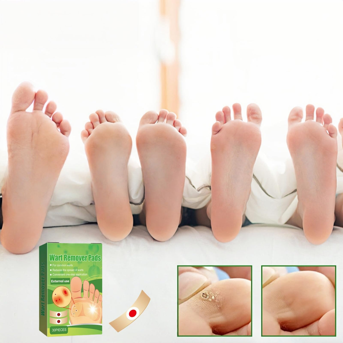 ShengQiu 30pcs Wart Remover,Verruca Treatment,Wart Remover for Hands,Plantar Wart R/emover for Feet,Effective Deep Verruca R/emoval Pads Patches for Adults