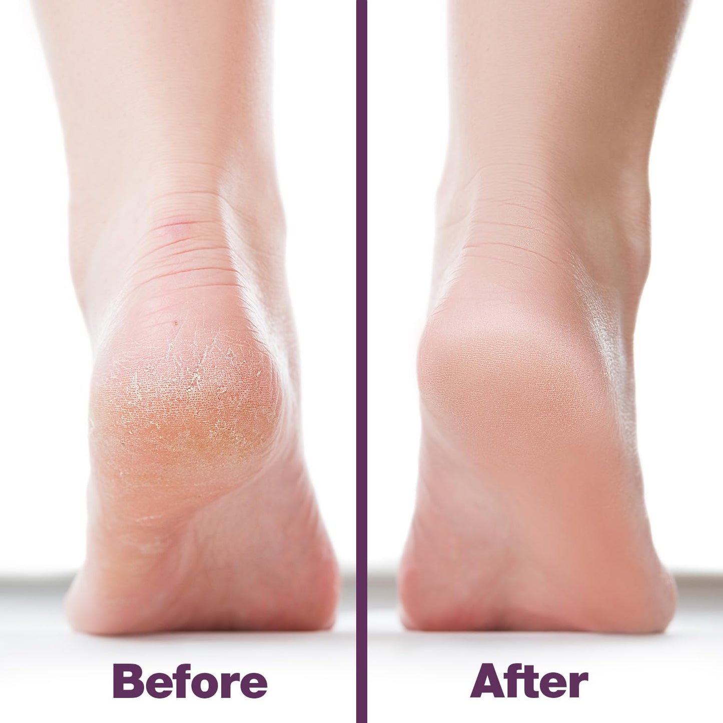 Probelle Double Sided Multidirectional Nickel Foot File Callus Remover - Immediately Reduces calluses and Corns to Powder for Instant Results, Safe Tool (Purple)