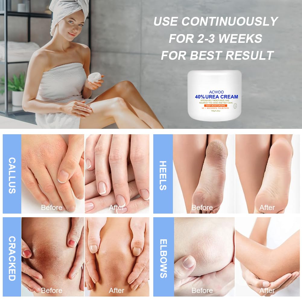 ACWOO Urea Cream 40%, Urea Foot Cream, 150g Urea Cream for Feet, Urea Foot & Hand Cream for Cracked Heels and Dry Skin, Foot Nourishing Frost for Callus Remover, 40% Urea Lotion for Feet
