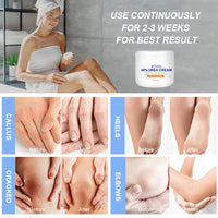 ACWOO Urea Cream 40%, Urea Foot Cream, 150g Urea Cream for Feet, Urea Foot & Hand Cream for Cracked Heels and Dry Skin, Foot Nourishing Frost for Callus Remover, 40% Urea Lotion for Feet