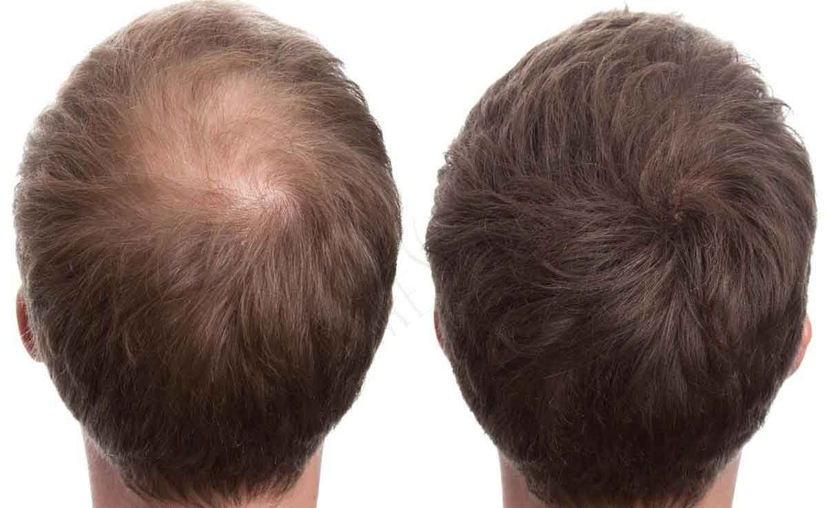 RESTRAND Hair Building Fibres. The Latest Generation of Fibres. Instantly Hide Hair Loss. 14 Colours Available, Large 28g Pot. (Dark Brown)