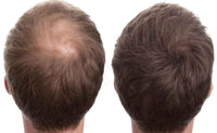 RESTRAND Hair Building Fibres. The Latest Generation of Fibres. Instantly Hide Hair Loss. 14 Colours Available, Large 28g Pot. (Dark Brown)