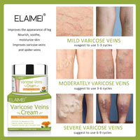 Solotree Varicose Veins Cream, Varicose Vein Treatment, Spider Vein Treatment Cream for Legs, Improve Blood Circulation, Tired and Heavy Legs Fast Relief