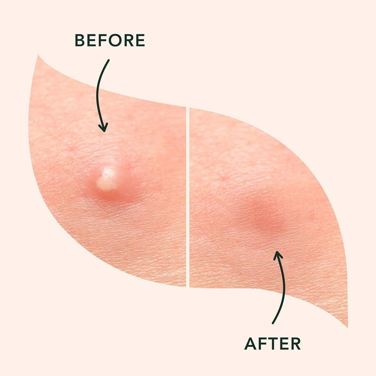 HERBENJOY Hydrocolloid Pimple Patches Spot Patches 144 Count Absorbing Cover Invisible Blemish Spot Treatment Facial Fast Acting Skincare Acne Patch Day and Night Use Acne Patches for Face