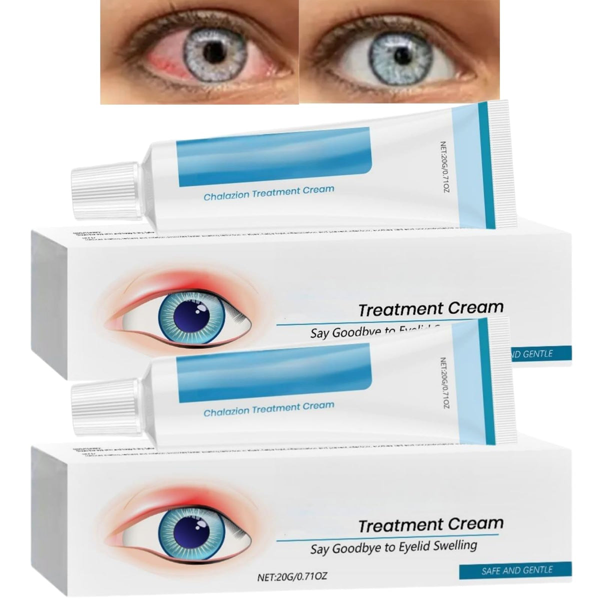 SingHao 2PCS Chala/zion Eye Treatment Cream,Stye Eye Treatment,Moisturizing Cream for Eyelids,Stye Treatment for Dry Eyes,Cha/lazion Treatment for St/ye,Gentle Eyelid Cre/am for Daily Eye Care,S/tye Eye