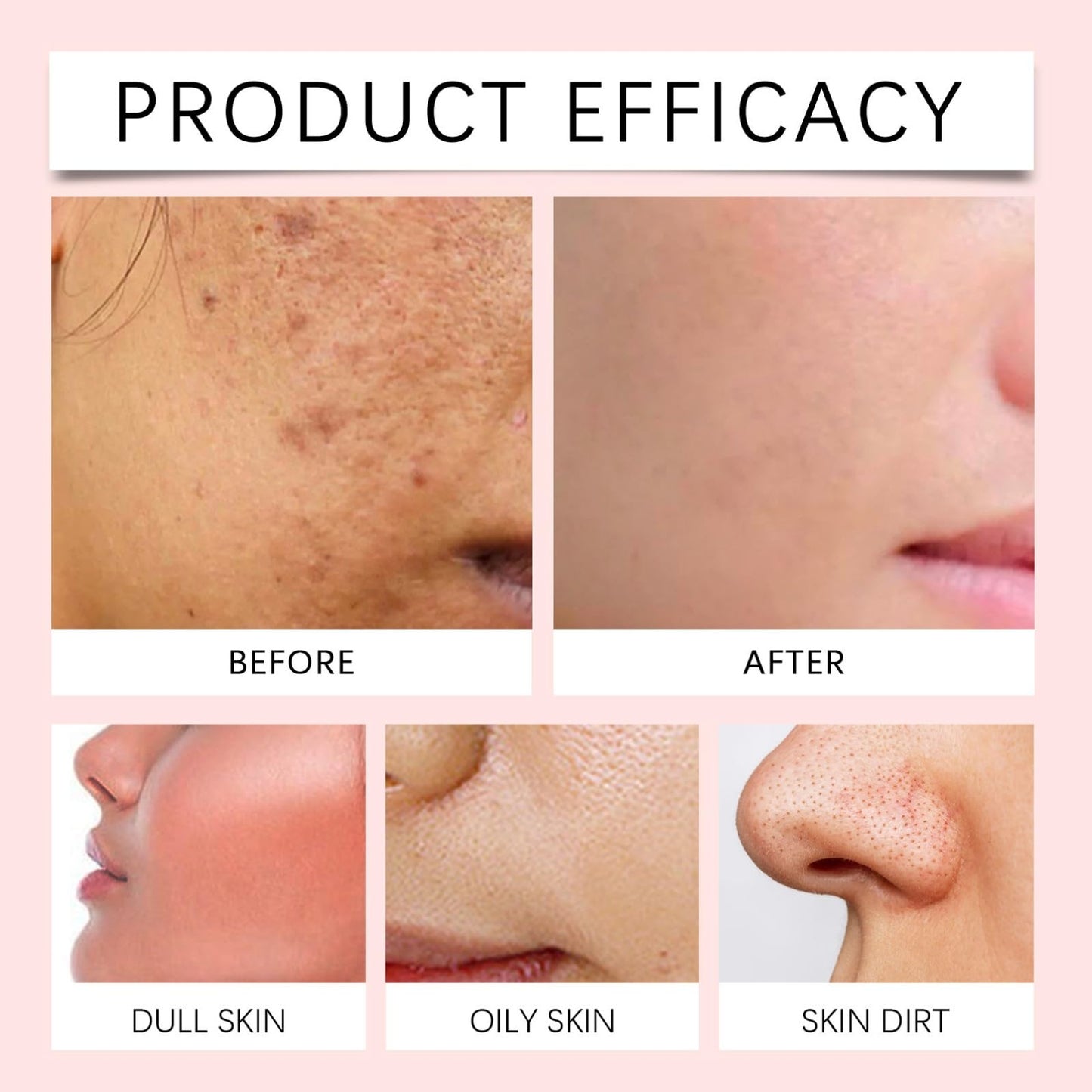 Ruojiar 70 Pads Red SUCC/inic Acid Panthe/NOL Face Exfoliator Pads,Exfoliating Toner Pa/ds for Acne Prone Skin,Zero Pore Pa/ds,for Exfoliation and Minimizing Po/res,Deep Clean Pores,Face Scrub Exfoliator