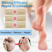 GNAPY Wart Removal Plasters, 24Pcs Wart Remover for Hands Feet Corn Removal Plaster with Hole, Remover Plantar Warts, Callus, Stops Wart Regrowth (A)