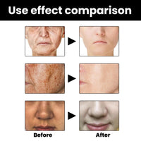 HIVETZ Aobenz Spot Remover for Face,Anti Spot Serum,Dark Spot Correcting Serum,Sun Spot Dark Spot Remover,Age Spot Treatment Face Serum,Skin Whitening Spot and Freckle Remover,Spot Treatment for Face,50ml