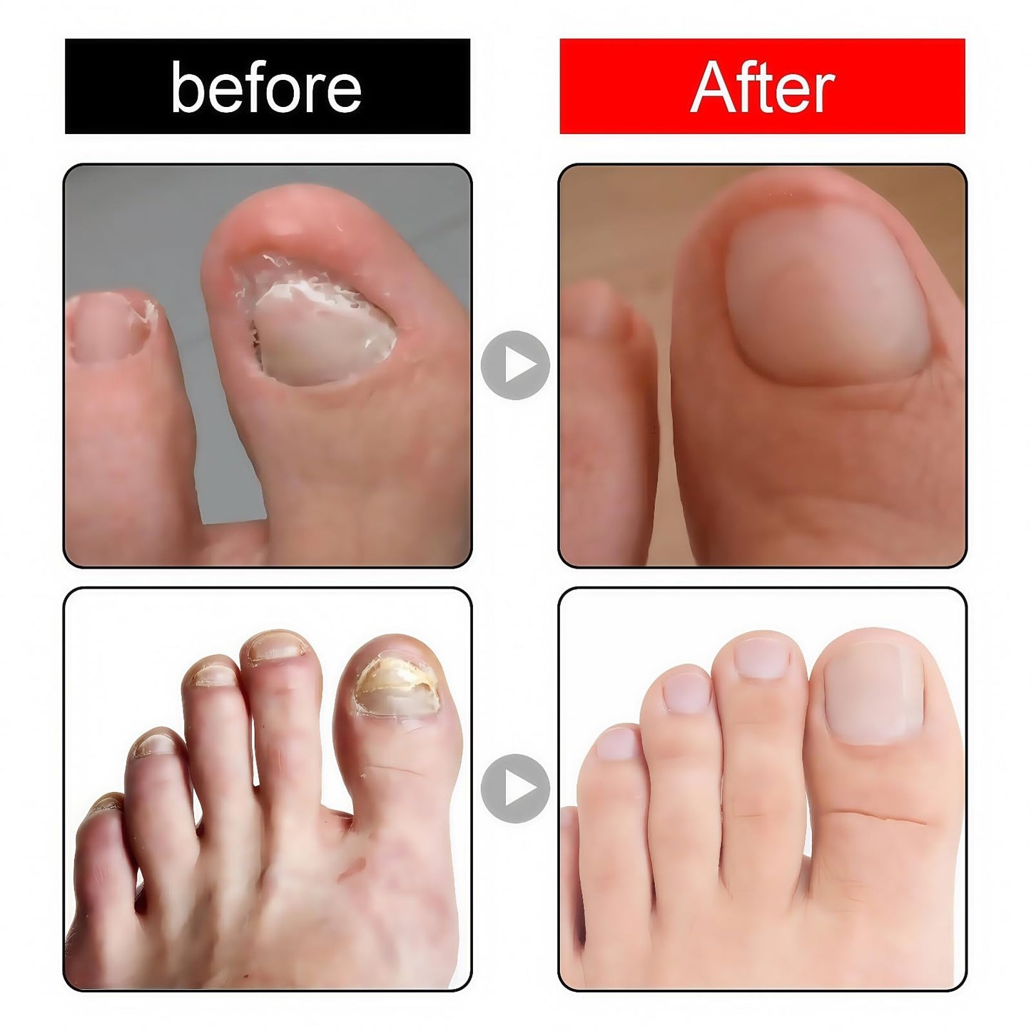 Ingrown Toenail Treatment Drop,Nail Growth Ingrowing Toenail Treatment,Cuticle Care Oils for Ingrown Toenails,Nail Growth Treatment,Ingrowing Toe Nail Treatment,Toe Nail Fungus Treatment Cuticle Oil