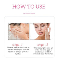 Azelaic Acid 15% Acne Tratment Gel,Azelaic Acid Serum Cream with Niacinamide & Vitamin C,Anti Acne Gel for Spot Prone Skin,Face Serum for Women,Hydrating Serum,Moisturiser Face,Serums Skincare