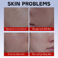 Freckle Removal Cream - Whitening Cream for Face - Whitening Freckle Creams for Acne Scar Removal - Anti Pigmentation Face Creams - Pigmentation Removal Face Creams - Face Cre-am for Women
