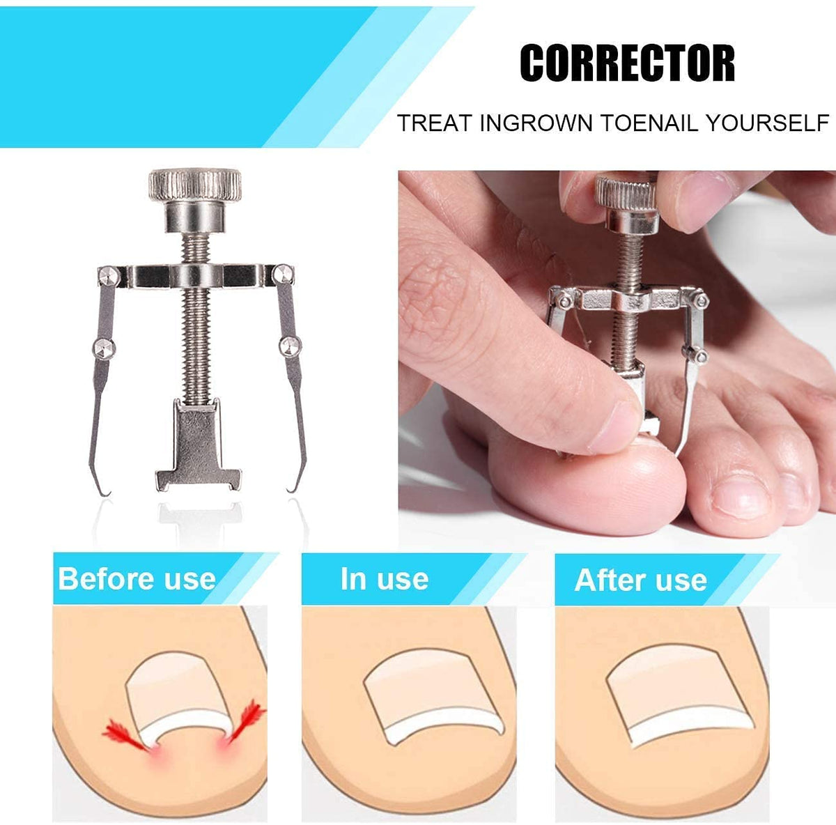 oosofitt Toenail Clippers Set 7Pcs, Staineless Steel Ingrown Toenail Tool Kit, Professional Toe Nail Nippers Set for Ingrown & Thick Nail, Surgery Grade Manicure Pedicure Tool By OosoFitt