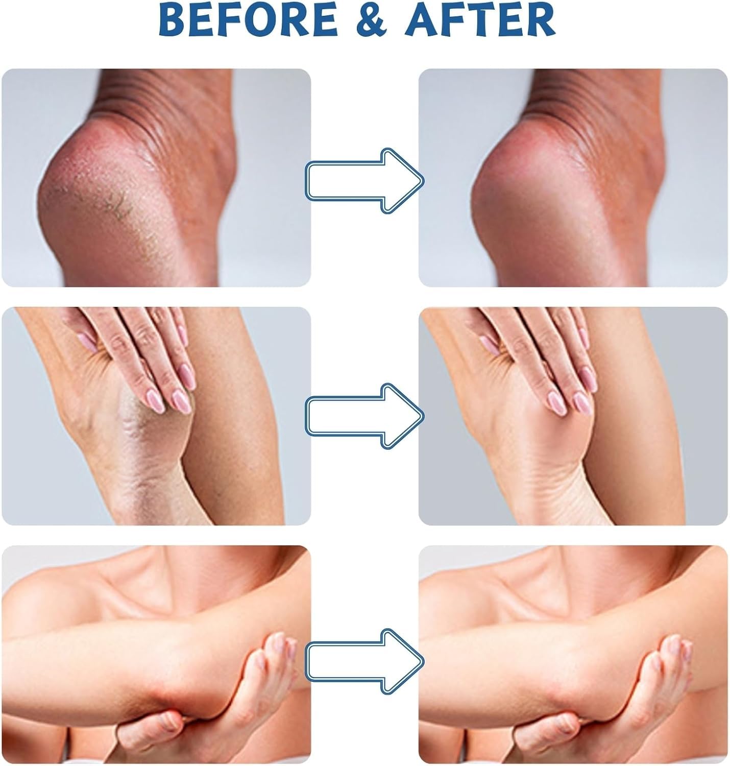 2PC Urea Cream 60 Percent for Feet, Cracked Heel Repair Cream Deeply Moisturizing with Aloe Vera, Urea Foot Cream for Cracked Heels and Dry Skin, Foot Moisturiser