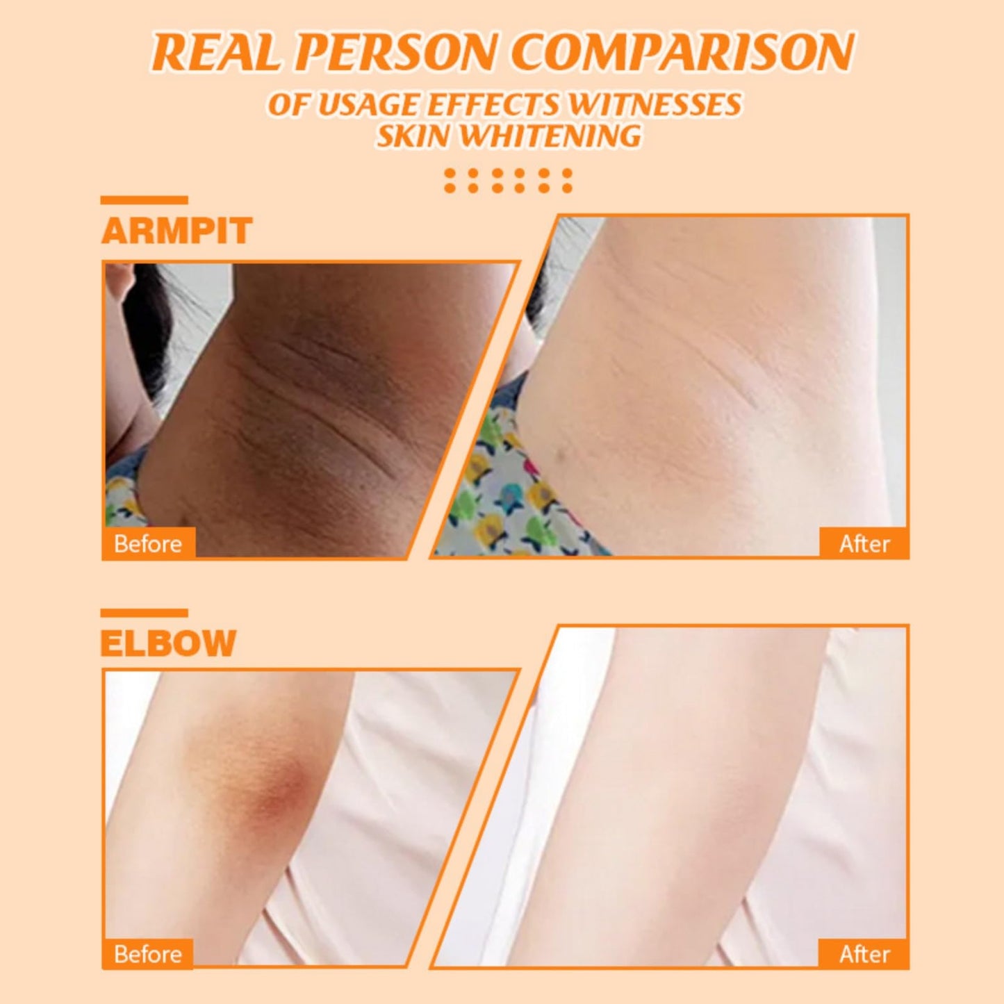 SEMECOMER Kojic Acid Underarm Whitening Cream, Skin Lightening Cream, Armpit Whitening Creams， Skin Bleaching for Armpits, Knees, Inner Thighs, Bikini, Intimate Areas, Reduces Odor, Absorbs Quickly