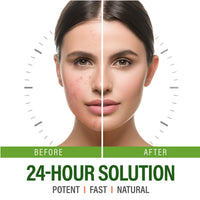 QEUTKEZS Herbal Acne Removing Cream,Professionally Remove Acne Marks,Gently Moisturize,Refreshing & Not Greasy,Improving Sensitive Skin Prone to Acne,Acne Scar Cream & Pimple Remover For All Skin Types