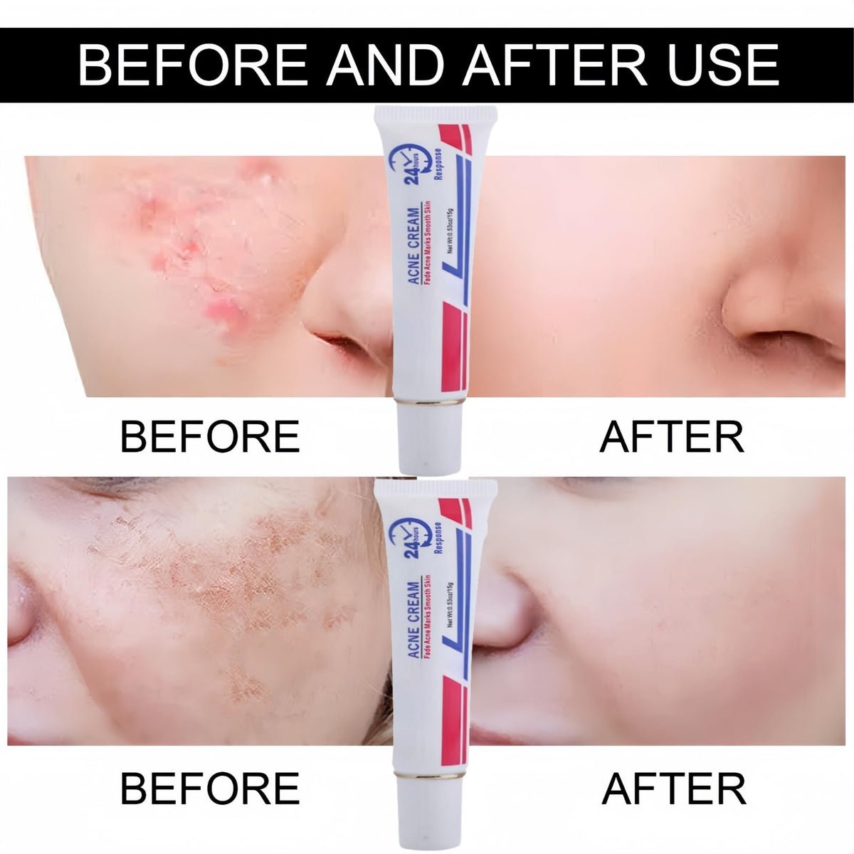QinZiEn Acid Spot Cream,Acne Treatment for Spot Prone Skin,Acne Scar Treatment,24-Hour Spot Reduction,Acne Cream,Dark Spot Remover for Face,A/nce Scar Removal C/ream,Spot Treat/ment,15g