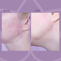BEVERLY HILLS Beverly Hills 7.5% Glycolic Acid Peel with Lactic Acid & Pyruvic Acid - Face Exfoliator of Damaged & Dead Skin | Anti Aging Chemical Exfoliant for Face for Fine Lines & Wrinkles | Made in USA, 50mL