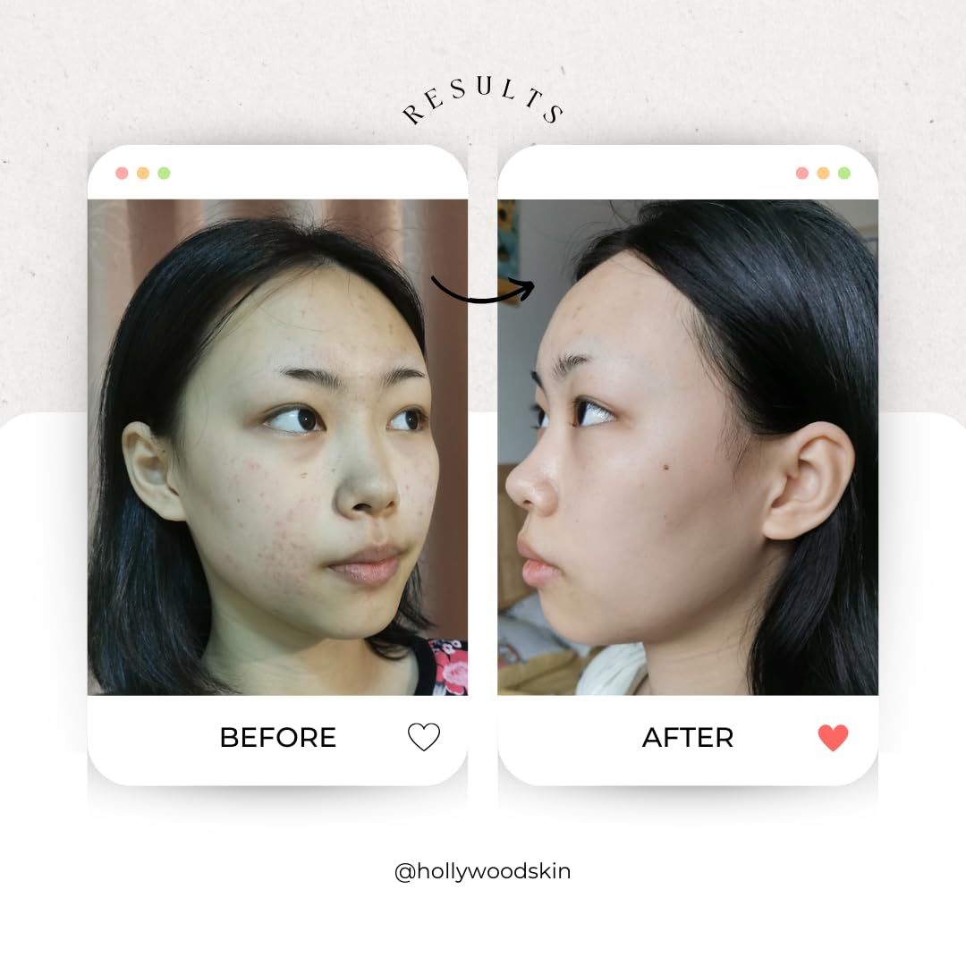 hollywoodskin Organic Salicylic acne cream. 4X STRONGER, 11X FASTER! Patented technology features Hyaluronic Acid (5%), Vitamins A and C + Tea Tree Oil. Target Blemishes. 50ml