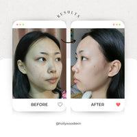 hollywoodskin Organic Salicylic acne cream. 4X STRONGER, 11X FASTER! Patented technology features Hyaluronic Acid (5%), Vitamins A and C + Tea Tree Oil. Target Blemishes. 50ml