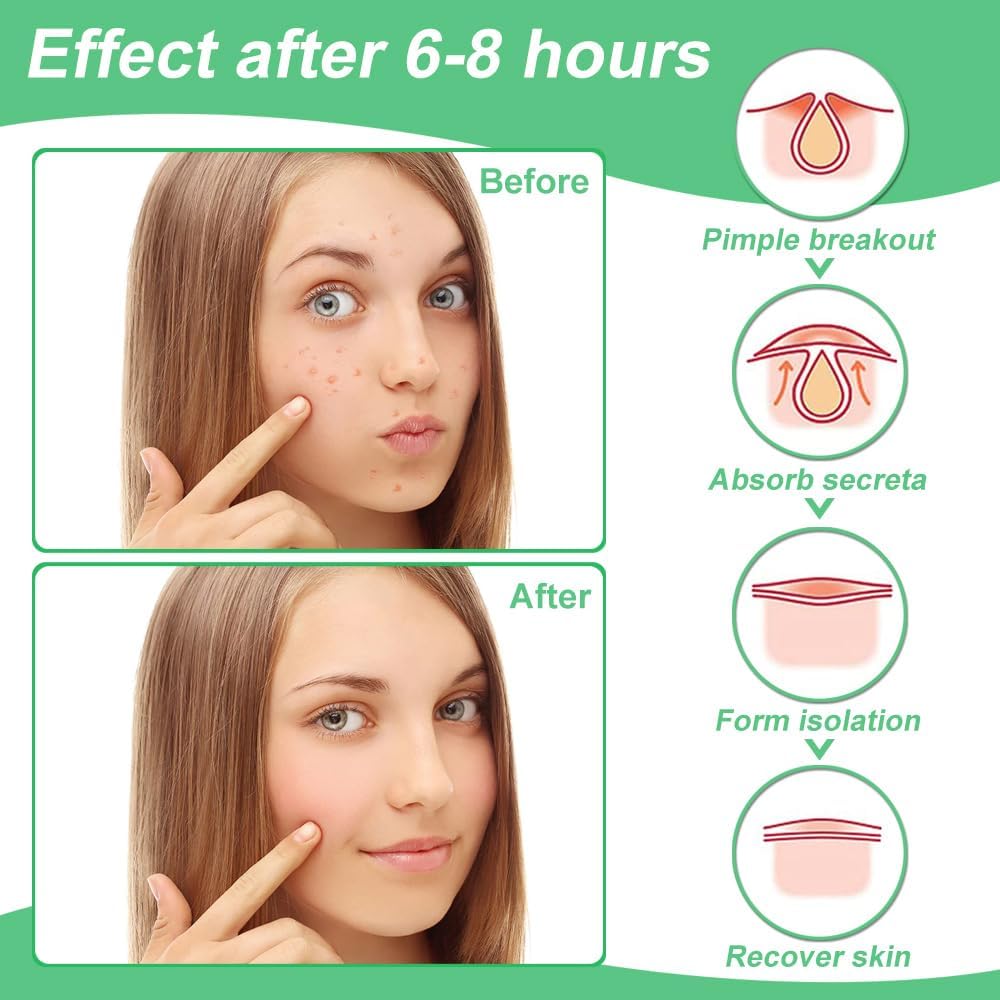 Zebrlan Pimple Patches 300 Counts Acne Patch Spot Patches Blemish Stickers Hydrocolloid Invisible Patches Spot Dots Acne Effectively Face Skin Care,4 Sizes