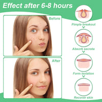 Zebrlan Pimple Patches 300 Counts Acne Patch Spot Patches Blemish Stickers Hydrocolloid Invisible Patches Spot Dots Acne Effectively Face Skin Care,4 Sizes
