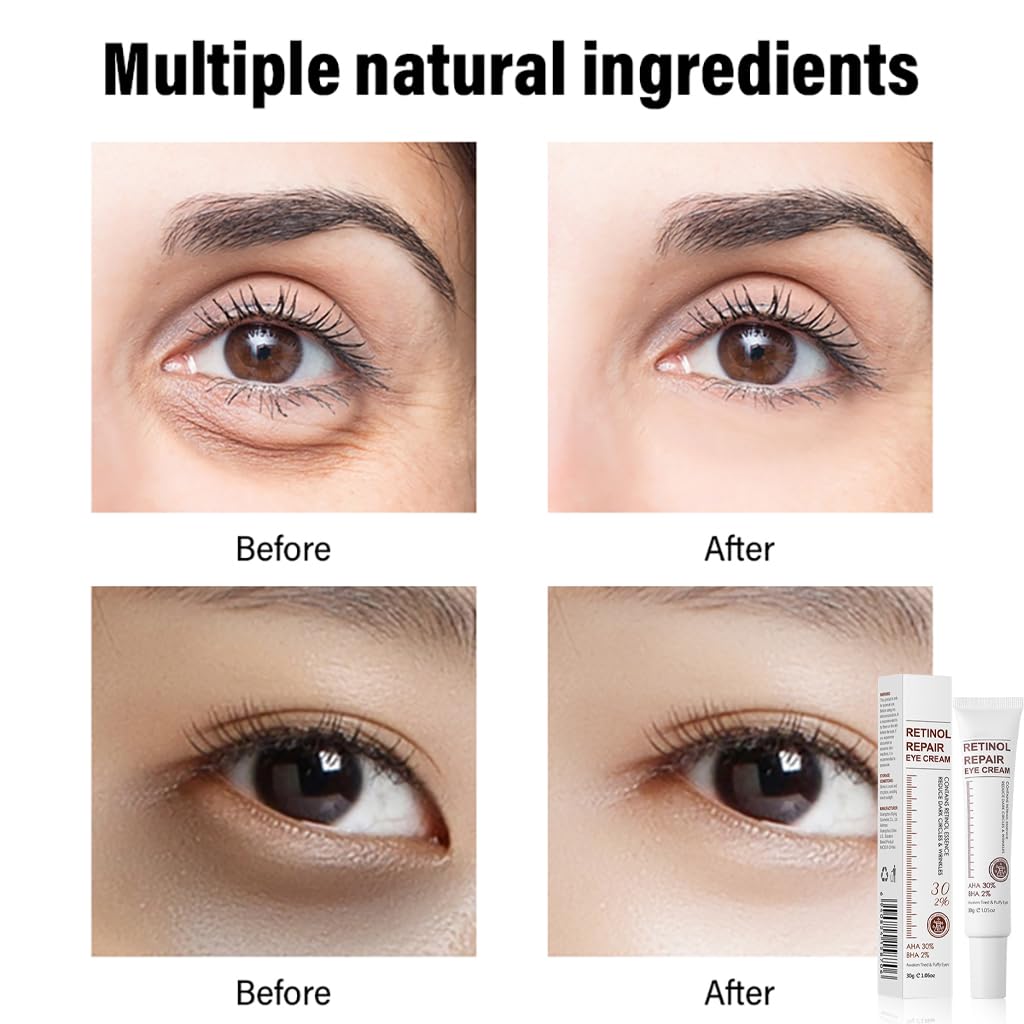 FPNNZ Retinol Eye Cream, Retinol Serum Eye Cream for Dark Circles and Puffy Eyes, Under Eye Cream with Retinol & AHA 30% & BHA 2% & Hyaluronic Acid for Fine Lines & Wrinkles Saggy Skin Puffy Eyes