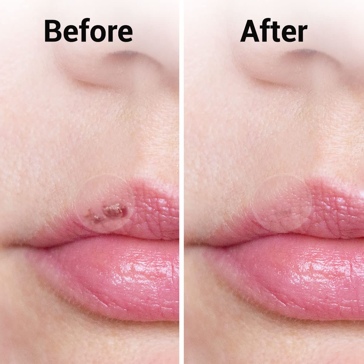 36pk Spot & Cold Sore Patches | 12pcs 8mm & 24pcs 12mm Skin Care Pimple Patches | Acne Patch Hydrocolloid Patches | Face Care Spot Patches | Pimple Patch Acne Patches Hydrocolloid Patch + SOL Sticker