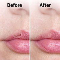 36pk Spot & Cold Sore Patches | 12pcs 8mm & 24pcs 12mm Skin Care Pimple Patches | Acne Patch Hydrocolloid Patches | Face Care Spot Patches | Pimple Patch Acne Patches Hydrocolloid Patch + SOL Sticker