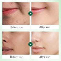 Boxiatil Salicylic Acid Serum + Cream