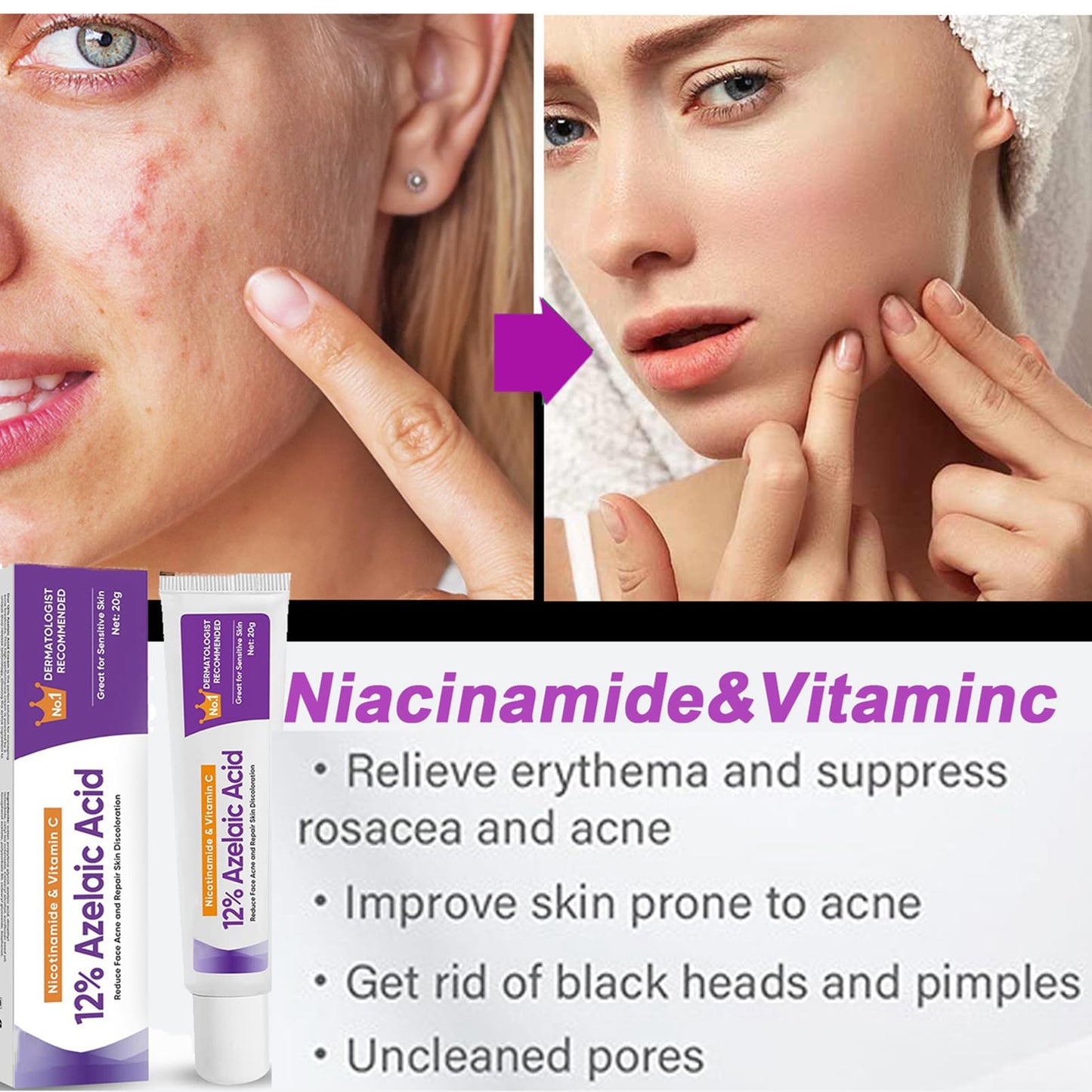 (2PCS)Azelaic Acid Face Cream, Azelaic Acid 12% Facial Serum Cream, Niacinamide & Vitamin C for Redness Face, Dark Spot, Rosacea,Acne,Face Skin Care Beauty Products,Skincare for All Skin Types 20G (2)