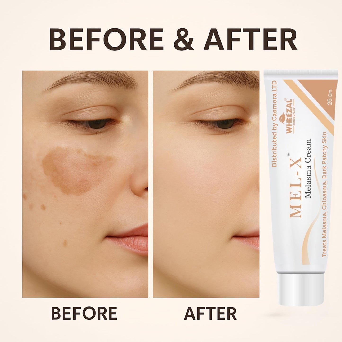 CAEMORA Melasma Cream | Fades Chloasma, Dark Spots & Uneven Skin Tone | Pigmentation | Protects Skin against Sunburn and Tanning