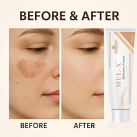 CAEMORA Melasma Cream | Fades Chloasma, Dark Spots & Uneven Skin Tone | Pigmentation | Protects Skin against Sunburn and Tanning
