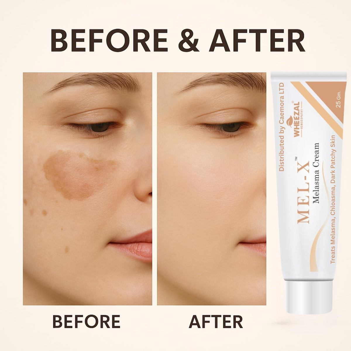 CAEMORA Melasma Cream | Fades Chloasma, Dark Spots & Uneven Skin Tone | Pigmentation | Protects Skin against Sunburn and Tanning