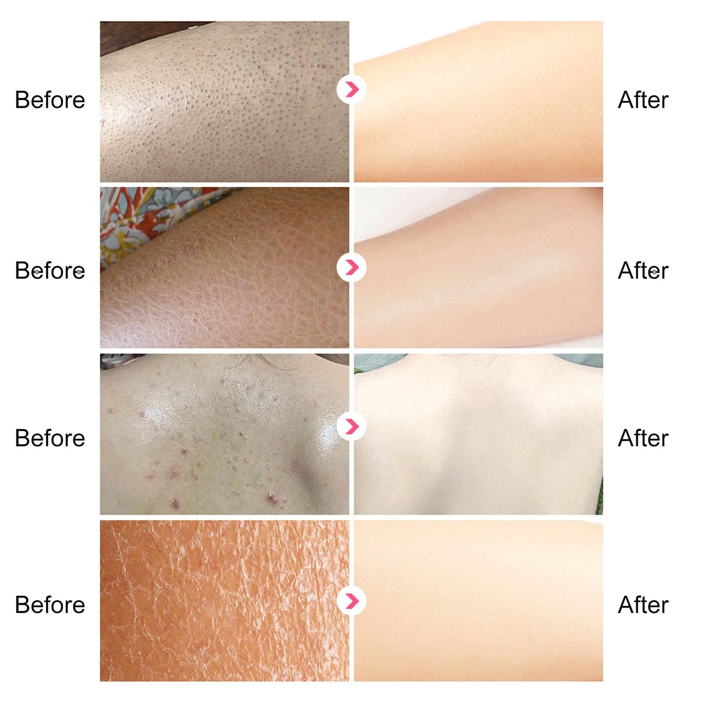 Grospe Skin Exfoliating Repair Cream, Chicken Skin Care Cream, Strawberry Legs Treatment Body Cream, Hydrating Moisturising Refreshing Skin Fragrance Repair Body Lotion 50g