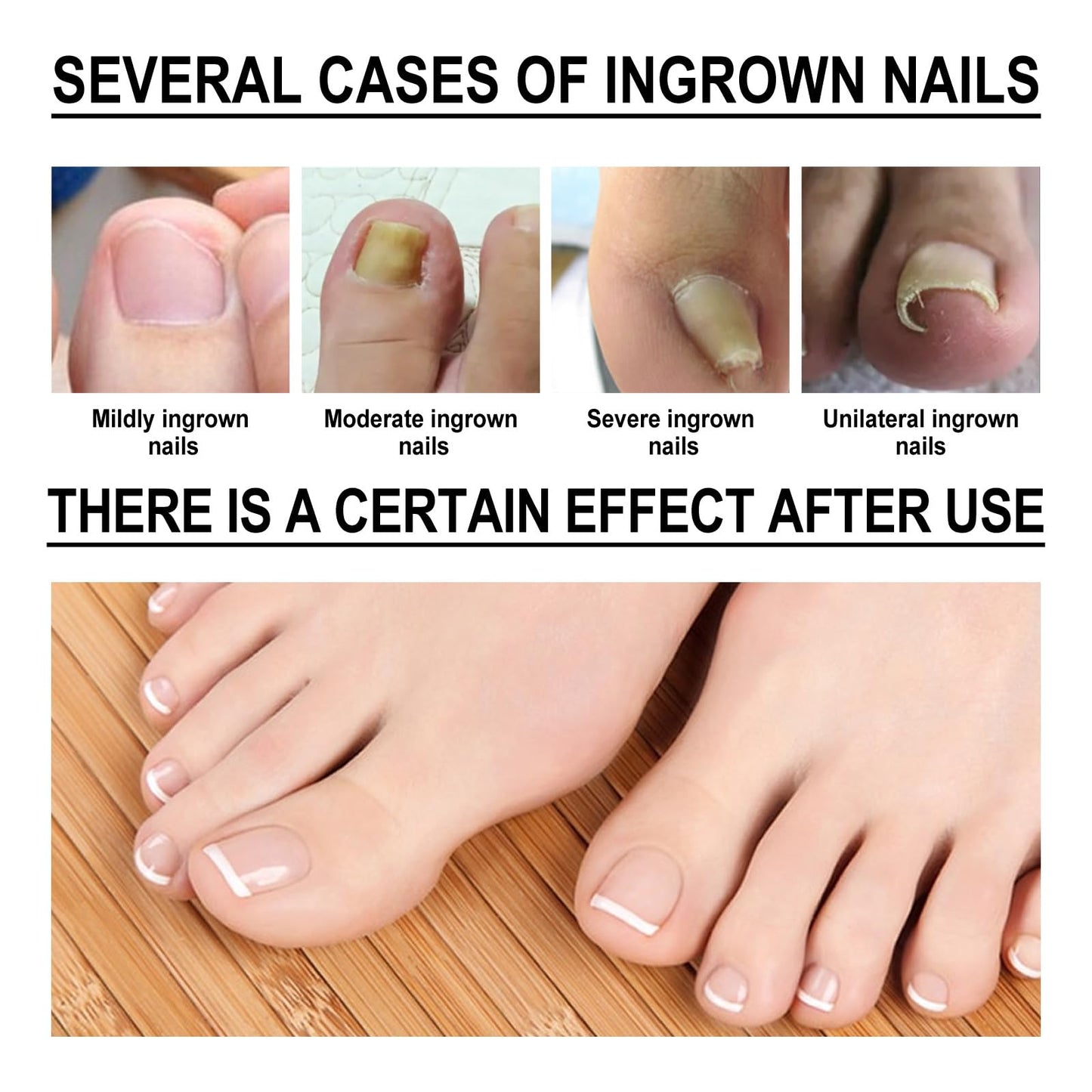 Fashion Base Ingrown Toenail Treatment Drop - Ingrown Toenail Treatment- Cuticle Care Oils for Ingrown Toenails - Trimming Toenail Softening Drops Natural Ingrown Toenail Correction Fungal Nail - 10ml