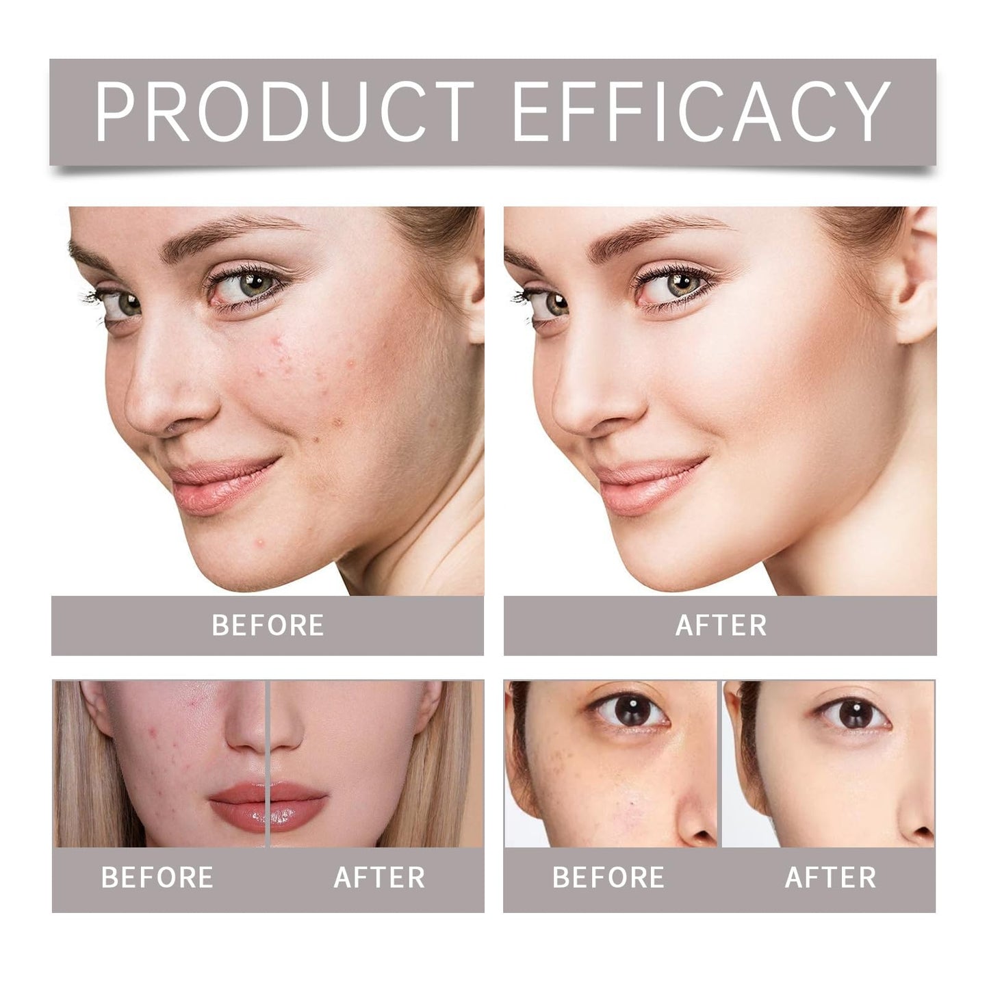 Acne Foaming Wash,Mild Daily Facial Cleanser for Deep Pore Cleansing,Acne Foa/m Wash,Gentle Daily Cleans/ing Foam,Clea/nsing Fo/am for Women,Facial Wash Women to Soothe Redness,Exfoliating Face Wash