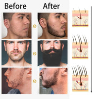 Beard Growth Kit,Beard Oil Beard Growth Serum for Men,0.5MM Derma Roller for Beard Growth,Beard Grooming Tools for Beard Rapid Growth and Thickening