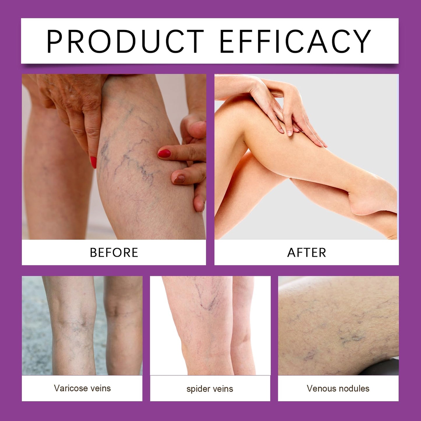 SONGQEE Soothing Leg Breathable Care Patches, Varicose Vein Patch, Improving Blood Circulation, Skin Body Care, for All Skin Types